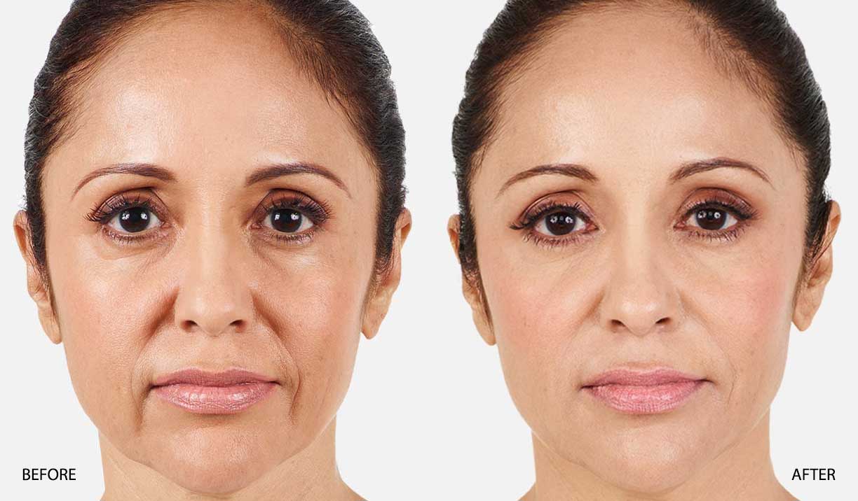 Nasolabial Folds Fillers Before And After